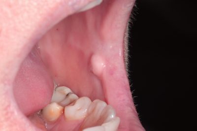 Intraoral biopsy