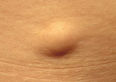 Lipoma photo